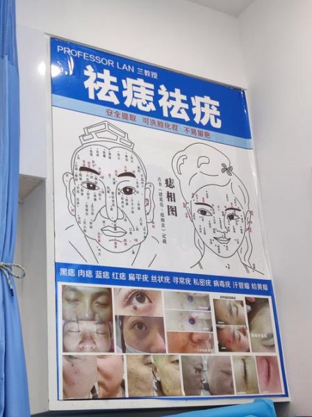 非物质文化遗产痣（非遗点痣技艺是什么）-第1张图片-八三百科