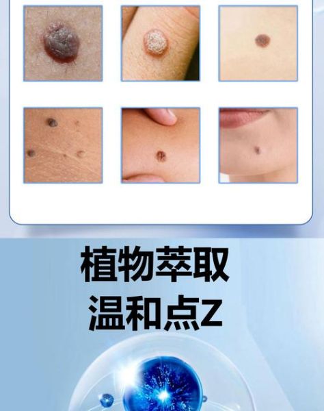 中药点痣非物质文化遗产(中药点痣是正宗非遗还是噱头)-第2张图片-八三百科 中药点痣非物质文化遗产(中药点痣是正宗非遗还是噱头)-第2张图片-八三百科